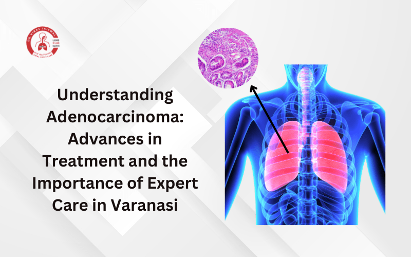 Adenocarcinoma